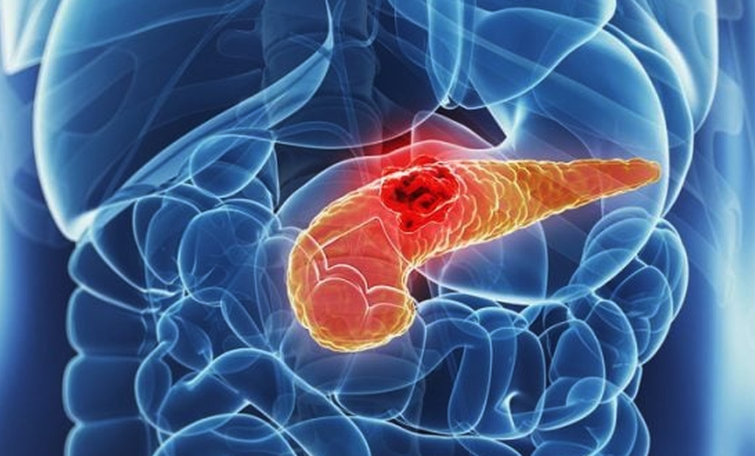 70% хворих помирають на першому році від діагнозу раку підшлункової
