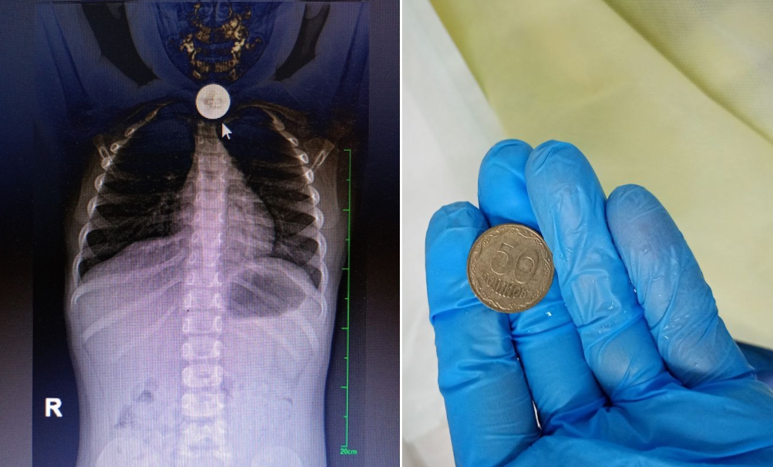 На Чернігівщині лікарі витягли зі стравоходу дитини велику монетуНа Чернігівщині лікарі витягли зі стравоходу дитини велику монету