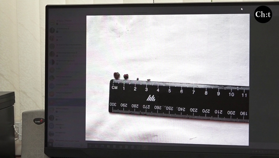 Чотири уламки змогли дістати з серця в обласній лікарні