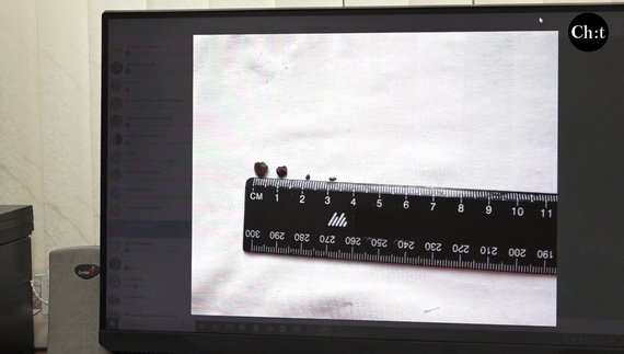 Чотири уламки змогли дістати з серця в обласній лікарні