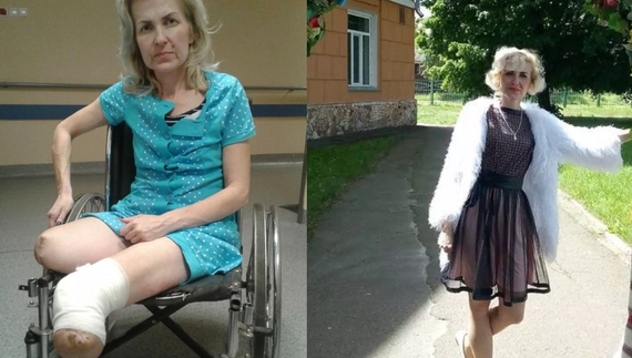 У Гомелі вчительці з Чернігова ампутували ноги – її поранило гранатою