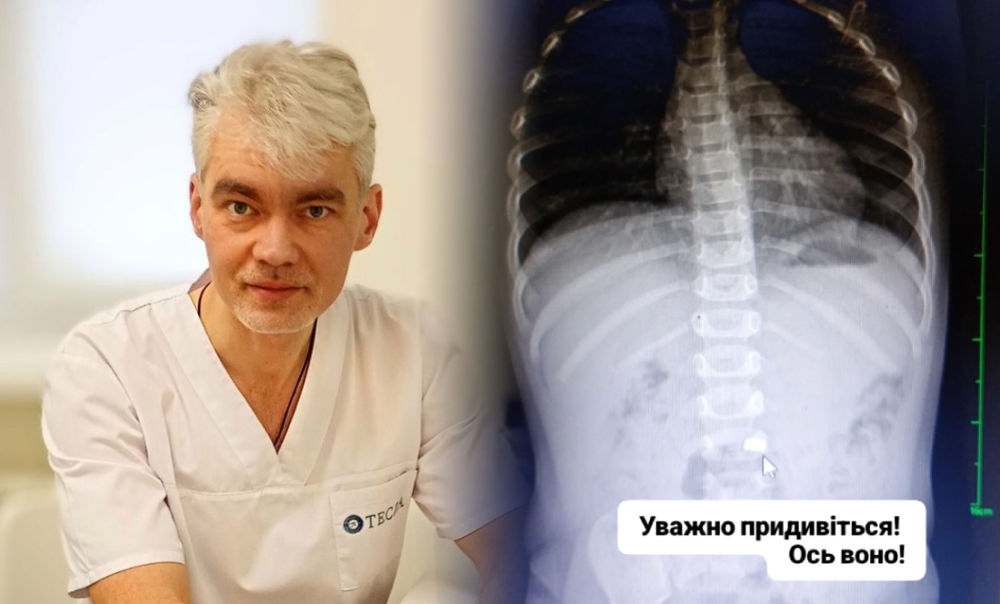 Дитина проковтнула батарейку: що порадив відомий чернігівський лікар