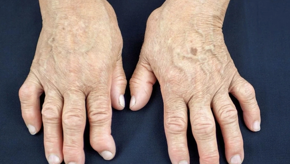 Ревматоїдний артрит — чим він небезпечний та як його лікувати