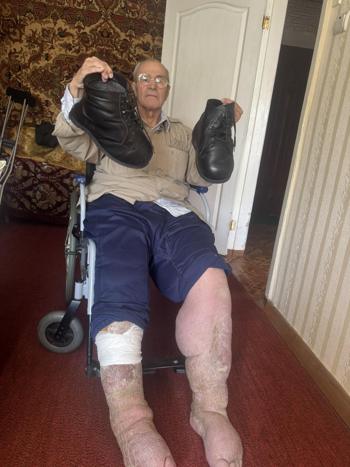 У Бориса Ковальчука слоновість ніг. У руках тримає взуття 47-го розміру